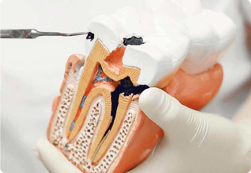 cavity filling diagram